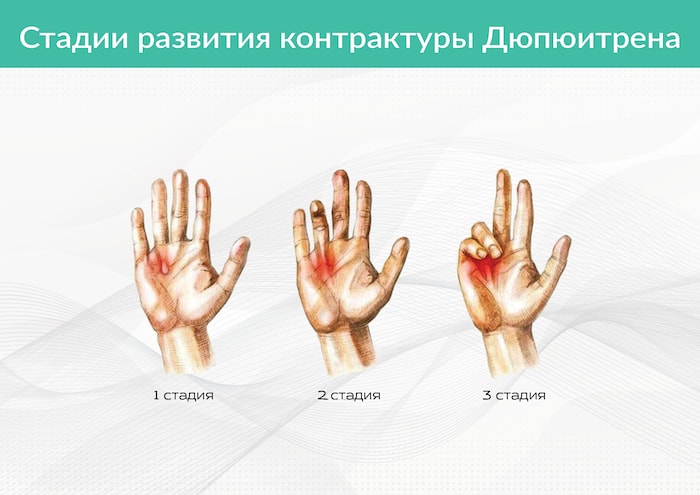 Сгибательная контрактура плечевого сустава. СПОСОБ ЛЕЧЕНИЯ СГИБАТЕЛЬНОЙ КОНТРАКТУРЫ КОЛЕННОГО СУСТАВА У ДЕТЕЙ С. Контрактура сустава, причины, симптомы и лечение | Заболевания суставов Плечо пловца - KinesioPro