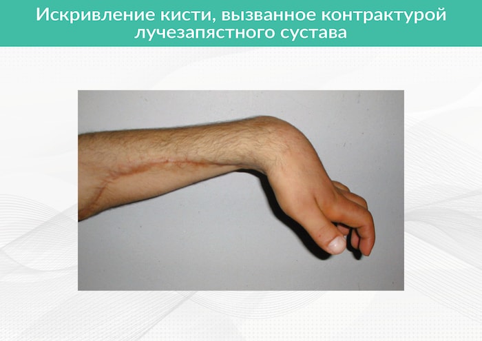 Сгибательная контрактура плечевого сустава. Плечевой Сустав Строение Фото — Фото Картинки Артроз плечевого сустава: симптомы, диагностика и лечение | athletic. Контрактура плечевого сустава: причины развития, сопутствующие симптомы.
