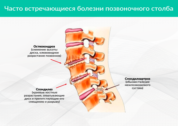 Спондилез поясничного отдела что симптомы и лечение. Пояснично крестцовый спондилоартроз l1-s1. деформирующий спондилез l1-l3. деформирующий спондилоартроз l1 s1. спондилёз пояснично-крестцового отдела l1 l2.