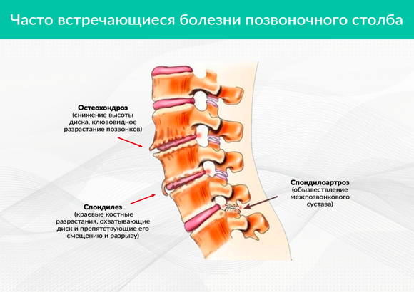 Пояснично крестцовый спондилоартроз l1-s1. Деформирующий спондилоартроз l1-s1. Спондилёз пояснично-крестцового отдела l1 l2. Деформирующий спондилез l2 l5. Спондилез l3