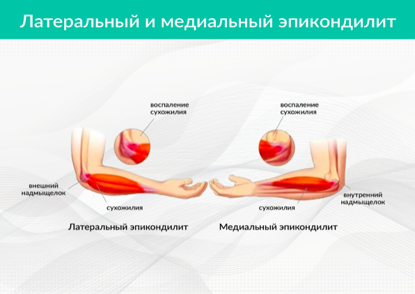 Латеральный эпикондилит локтевого сустава что. Эпикондилит локтевого сустава психосоматика. Локоть теннисиста латеральный эпикондилит. Медиальный внутренний эпикондилит. Латеральный и медиальный эпикондилит локтевого сустава
