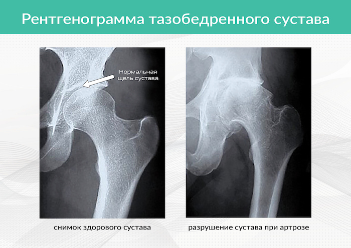 Операция тазобедренного сустава 1 степени